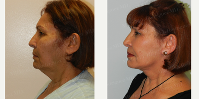 Brow Lift before and after photo
