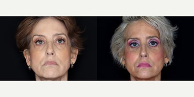 Eyelid Surgery before and after photo