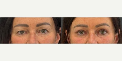 Eyelid Surgery before and after photo