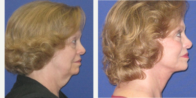 Facelift before and after photo