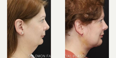 FaceTite before and after photo