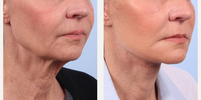 Facial Fat Transfer before and after photo