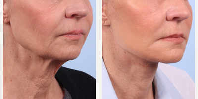 Facial Fat Transfer before and after photo