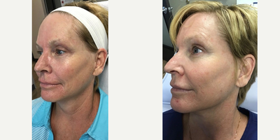 Halo Laser before and after photo