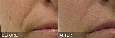 HydraFacial before and after photo