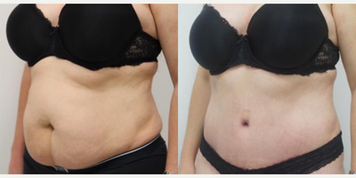 Liposuction before and after photo