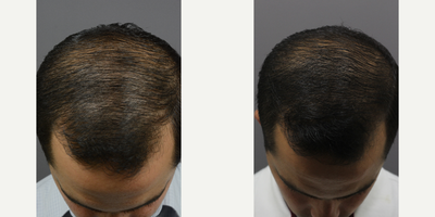 PRP for Hair Loss before and after photo