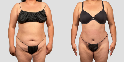 Tummy Tuck before and after photo