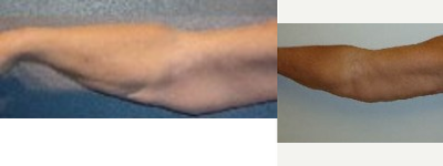 Arm Lift before and after photo