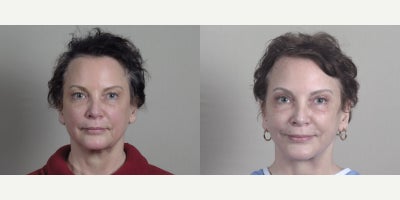 Chin Implant before and after photo