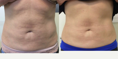 CoolSculpting before and after photo