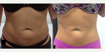 Exilis before and after photo