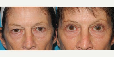 Eyelid Surgery before and after photo