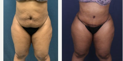 Liposuction before and after photo