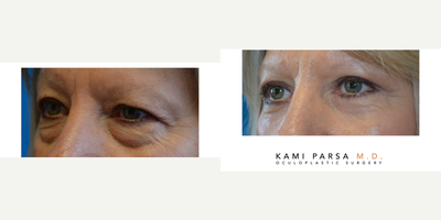 Brow Lift before and after photo