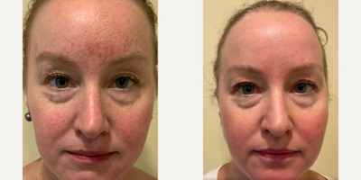 Laser Resurfacing before and after photo