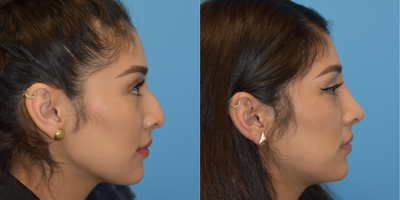 Nonsurgical Nose Job before and after photo