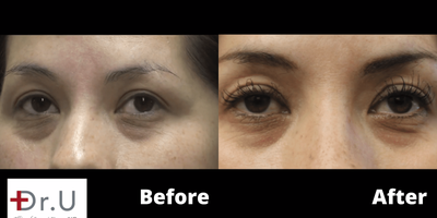 Eyelash Transplant before and after photo
