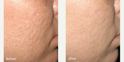 Morpheus8 before and after photo