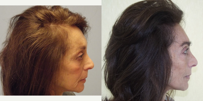 NeoGraft before and after photo