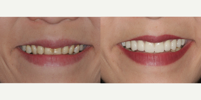 Dental Crown before and after photo