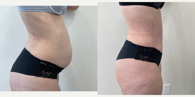 Drainless Tummy Tuck before and after photo