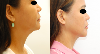 Kybella before and after photo