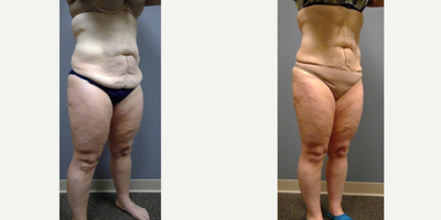 UltraShape Power before and after photo