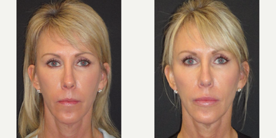 Voluma before and after photo