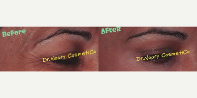 Botox before and after photo
