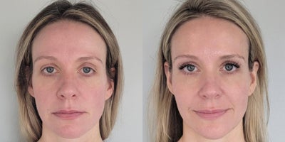 Cheek Fillers before and after photo
