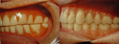 Dental Implants before and after photo