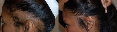 Hair Transplant before and after photo