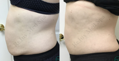 Smart Lipo before and after photo