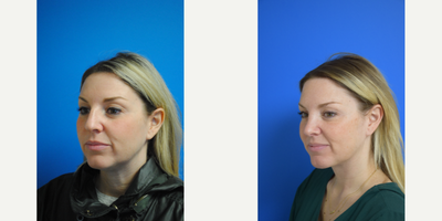 Chin Liposuction before and after photo