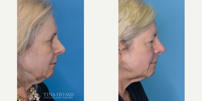 CO2 Laser before and after photo