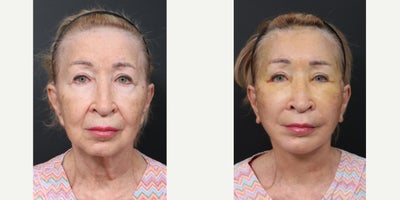 Deep Plane Facelift before and after photo