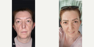 Eyelid Surgery before and after photo
