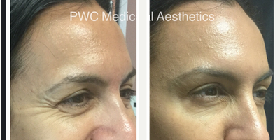 Xeomin before and after photo