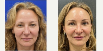 Eyelid Surgery before and after photo
