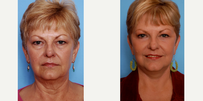 Facelift before and after photo