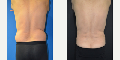 Liposuction before and after photo