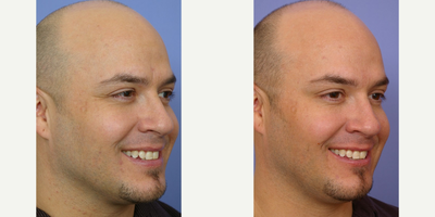 Botox before and after photo