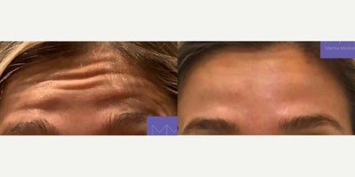 Botox before and after photo