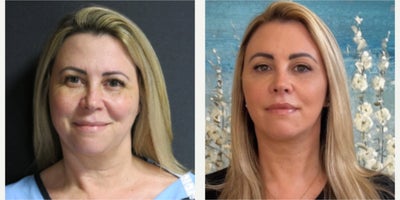 Facelift before and after photo