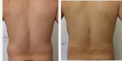 Liposculpture before and after photo