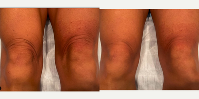 Morpheus8 before and after photo