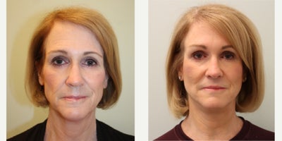 Lip Lift before and after photo