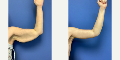 Arm Lift before and after photo