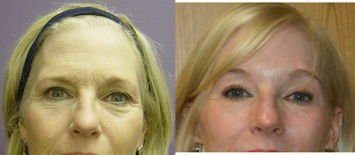 Eyelid Surgery before and after photo